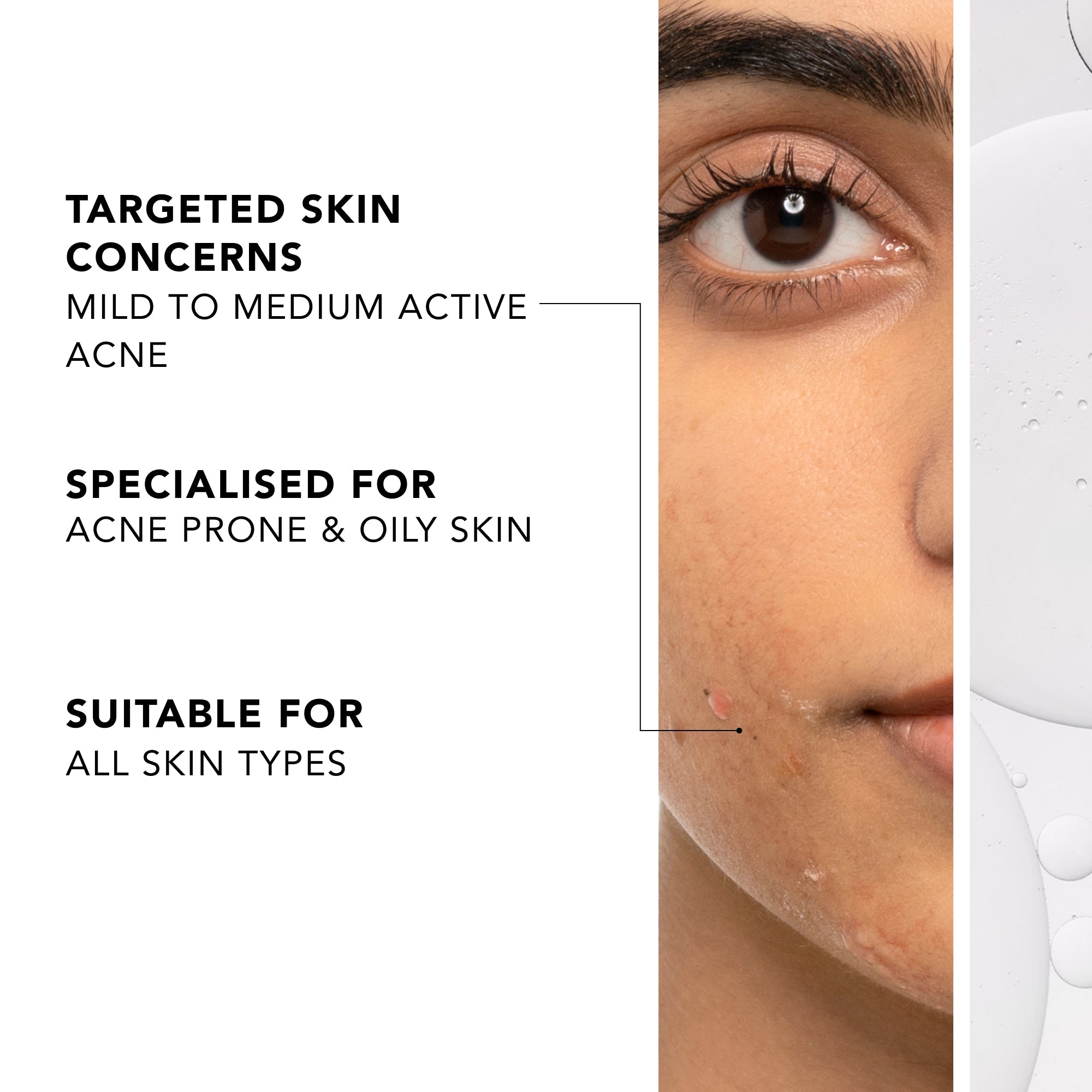 Acne Spot Correction Regime